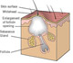 comedone image